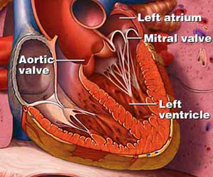 Mitral Valve Repair Less Risky Than Replacement - Space Coast Daily