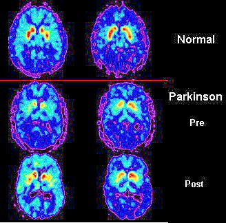 Early signs of Parkinson's Disease may be mild and may go unnoticed. Symptoms often begin on one side of the body and usually remain worse on that side, even after symptoms begin to affect both sides. 