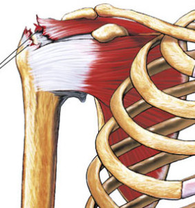 The arrows above indicate a tear in the supraspinatus tendon of the rotator cuff.