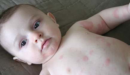 HEALTH TIPS: Dermatologists Share Advice On Treating Hives In Children ...