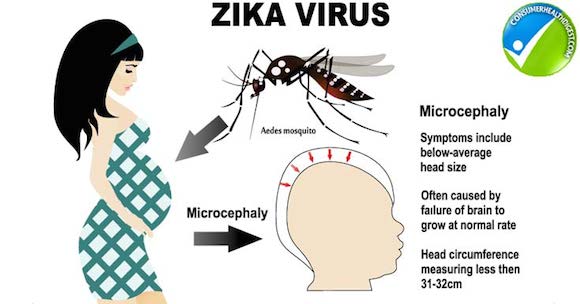 zika-virus-and-pregnancy