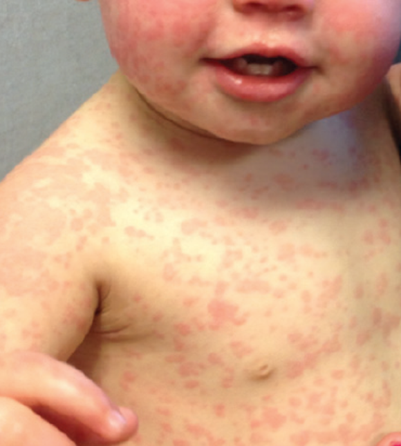 Health Spotlight Antibiotic Allergies In Children Are We Mislabeling Many Of Them